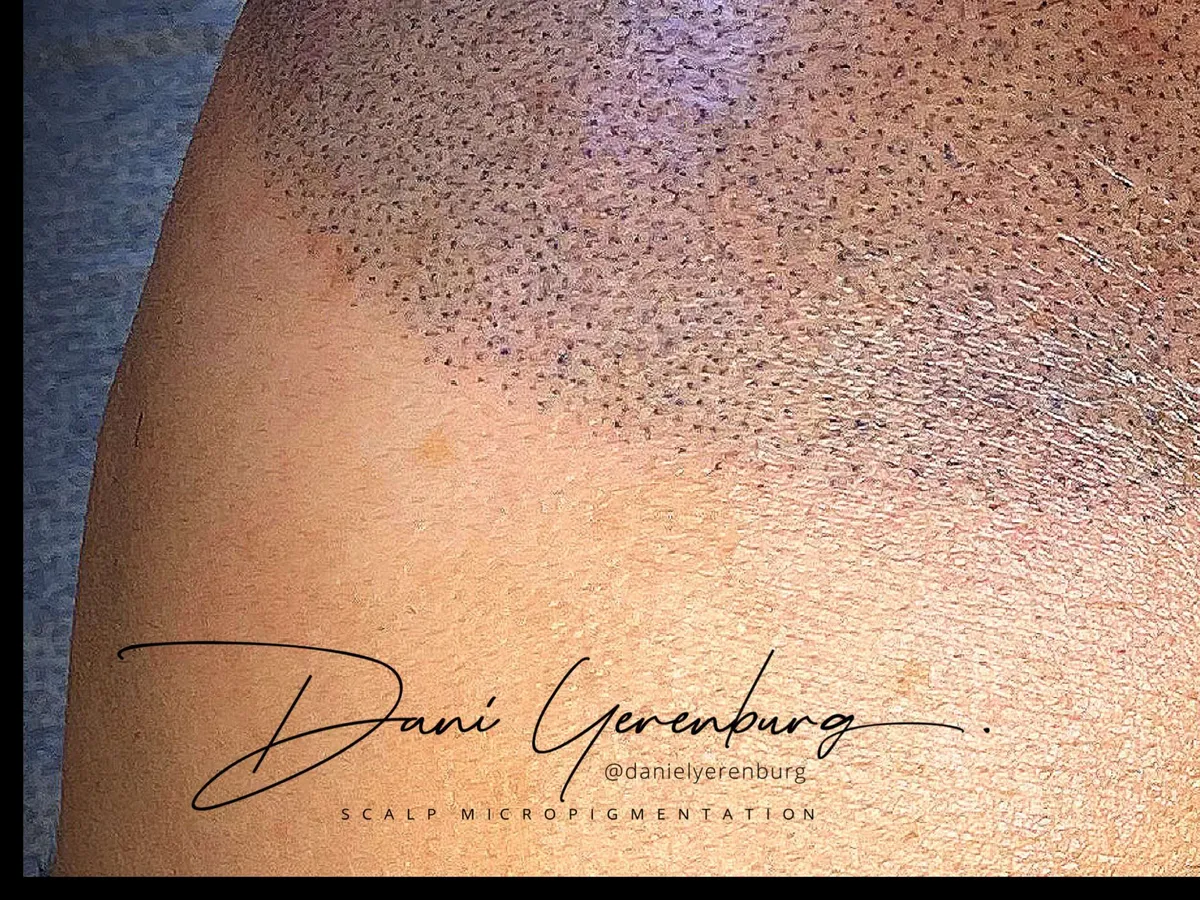 A restored hairline after scalp micropigmentation