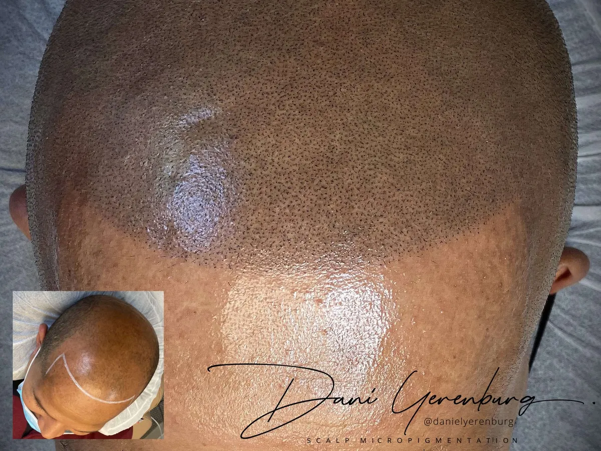 Added density on a thinning crown after scalp micropigmentation