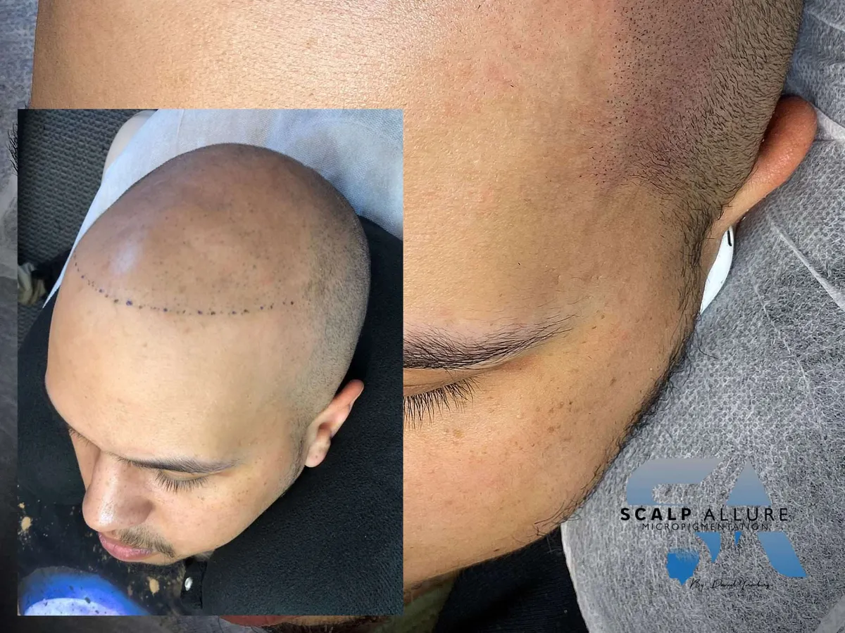A restored hairline after scalp micropigmentation, with the before inset